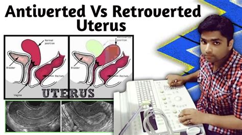 anteverted uterus tagalog